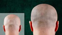 Haarpigmentierung nach Haartransplantation, FUE / FUT Narben, SMP Bayern - Landsberg (Lech) Vorschau